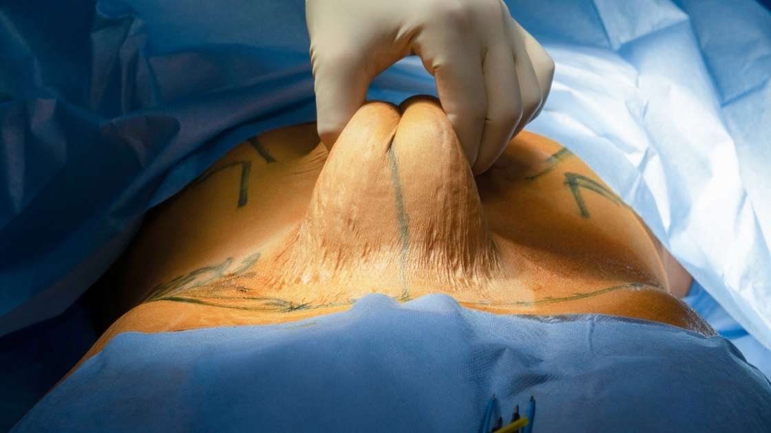 1 Jak przebiega rekonwalescencja po abdominoplastyce