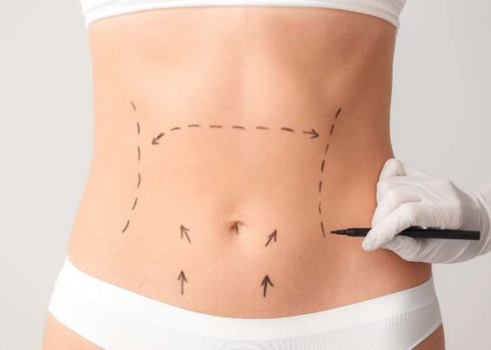 Jak wygląda brzuch po abdominoplastyce?