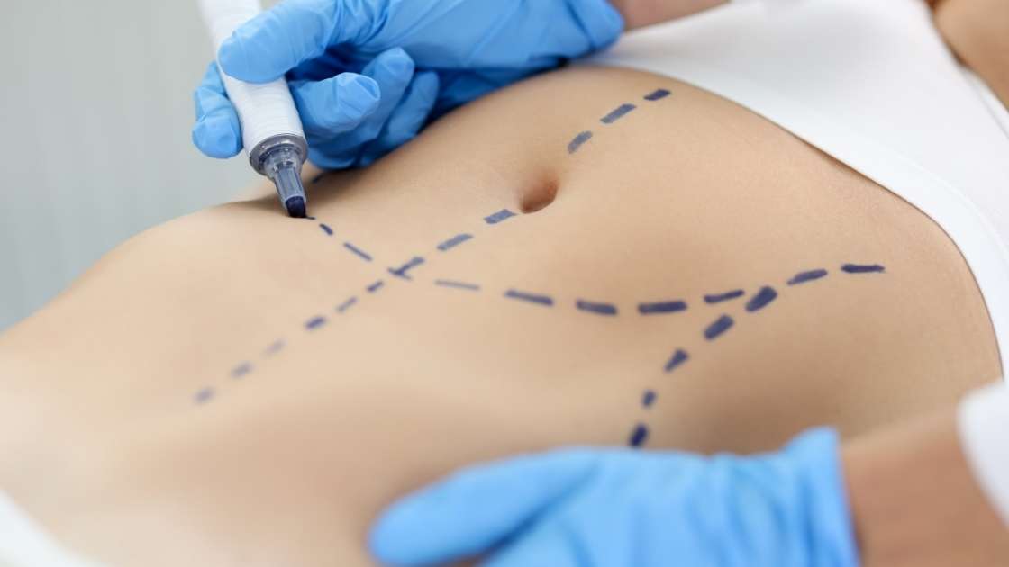 3 Czy lokalizacja kliniki wpływa na cenę abdominoplastyki