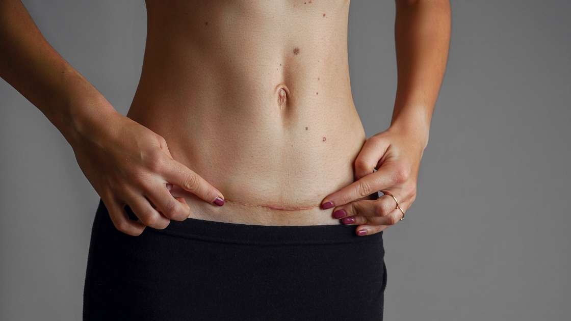 5 Jak pielęgnować bliznę po abdominoplastyce dla najlepszych efektów