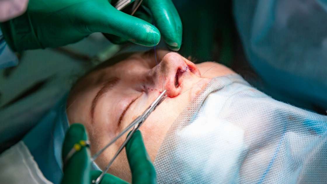 9 Jak przebiega proces rekonwalescencji po operacji nosa